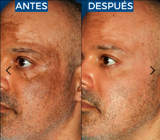Abera Suero de retinol para hombre