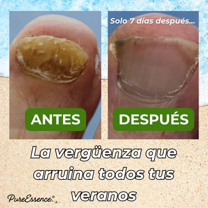 Ocultas tus uñas? PureEssence® las cambia en 7 días