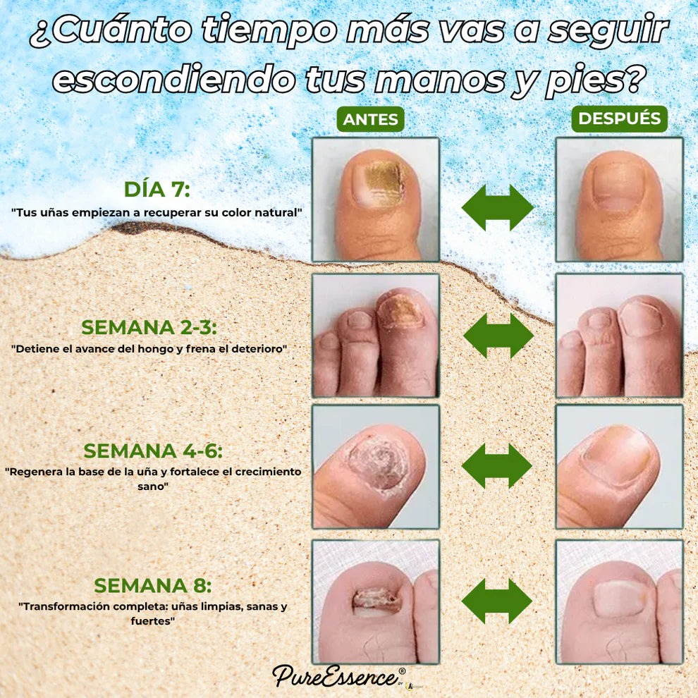 Ocultas tus uñas? PureEssence® las cambia en 7 días