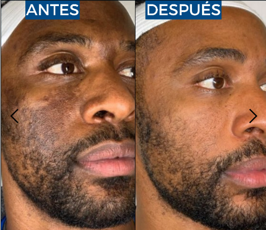 Abera Suero de retinol para hombre